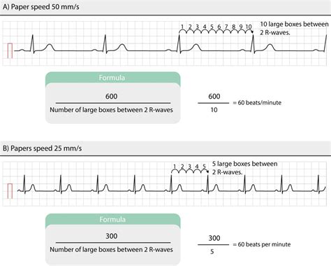 Sinus rhythm: physiology, ECG criteria & clinical implications.